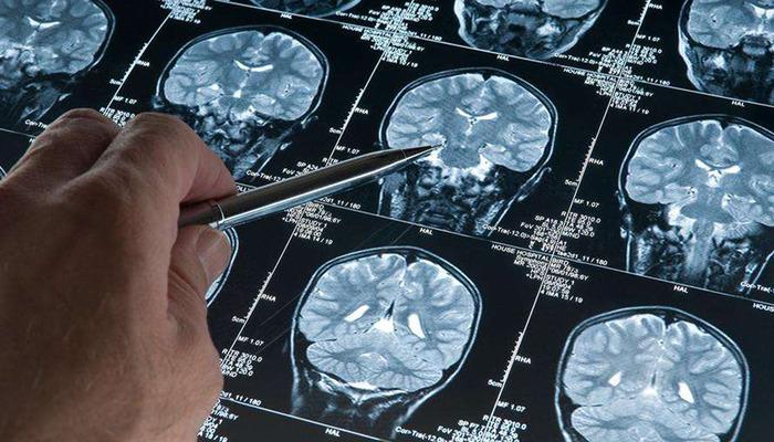 Erkeklerde gizli tehlike! Alzheimer araştırmalarında, demans riskini artıran genetik varyant bulundu: Bu varyanta sahip erkeklerde gelişme riski 2,39 1 20392286
