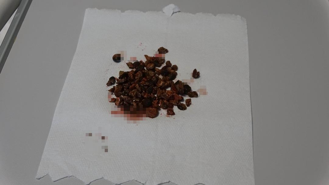 Doktorları şaşırtan durum: adamın böbreğinden yaklaşık 100 taş: 