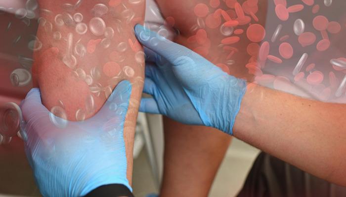 Modern çağın en sinsi ve ölümcül hastalığı: Türkiye'de her yıl 30 bin kişi tromboz nedeniyle hayatını kaybediyor! 1 21700511